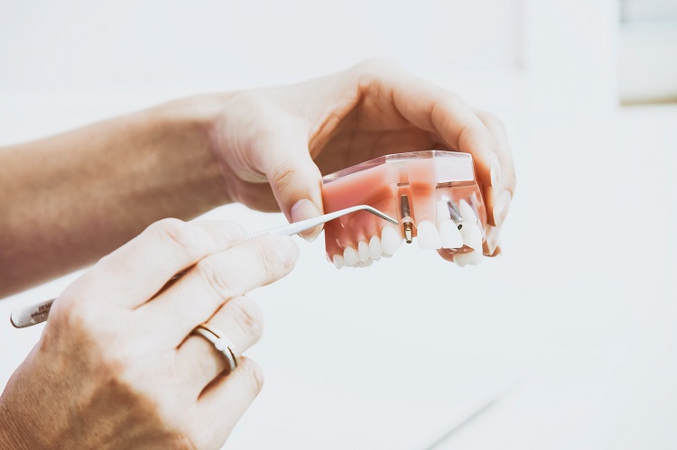 Dental Implants: What, Why, and How to Get One Done.