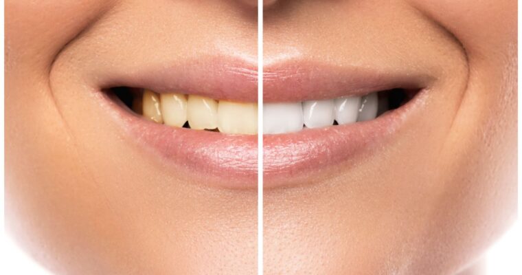 Zoom Whitening In Hamilton: Have A Successful Teeth Whitening Treatment!