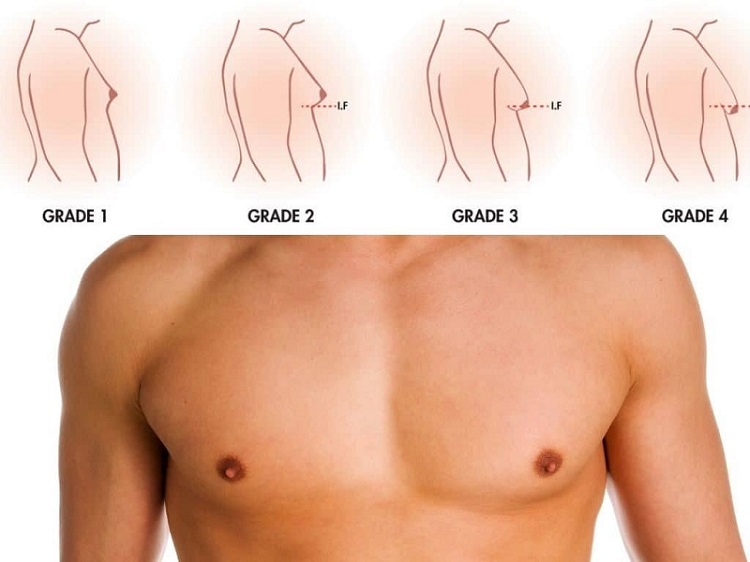 How Does Gynecomastia Surgery Work?