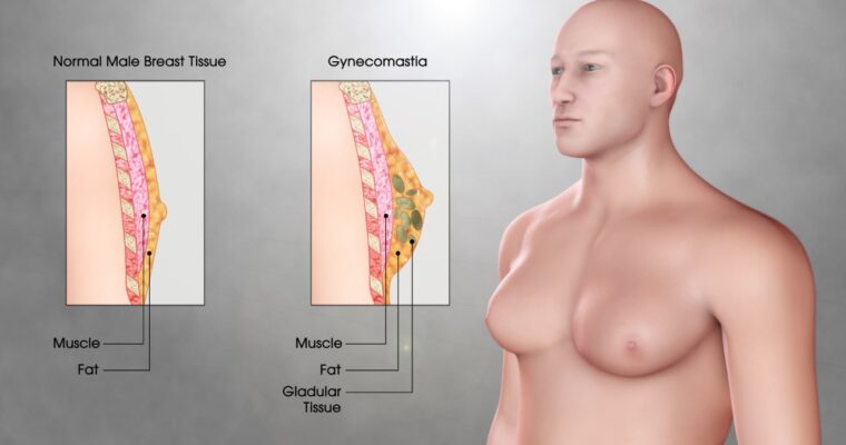 Benefits of Gynecomastia Surgery Gynaecomastia Treatment in Ludhiana