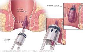 ClearMed Is the Solution to Your Hemorrhoid Woes