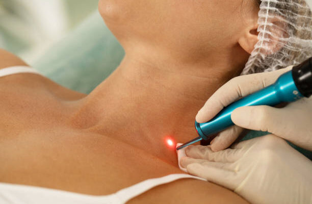 Need Help Fading Your Uneven Skin Pigmentation? Try a Laser Treatment!