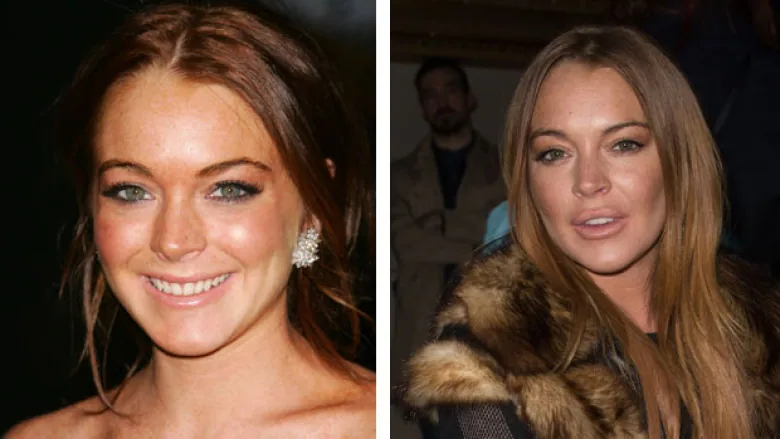 Why Lindsay Dee Lohan Had Plastic Surgery