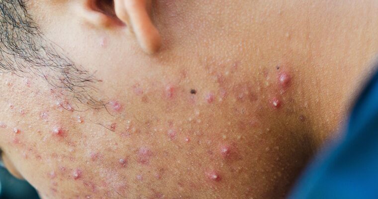 Acne: What is It, the Causes & Treatments