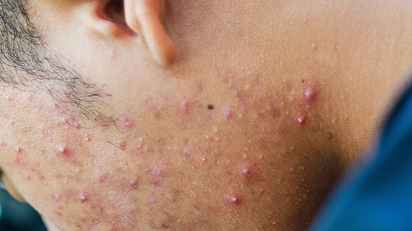 Acne: What is It, the Causes & Treatments